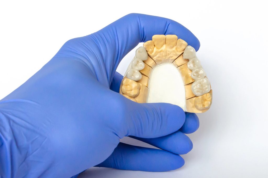 Fixed Dental Bridges: A Reliable Solution for Missing Teeth 1 A gloved hand holding a dental model of the upper teeth, showing crowns and restorations against a white background.